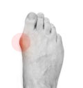 Varus valgus and Hallux valgus, bunion on white background Royalty Free Stock Photo