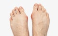 Varus valgus and Hallux valgus, bunion on white background Royalty Free Stock Photo