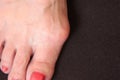 Varus valgus and Hallux valgus or bunion on middle aged woman foot. Isolated closeup on dark background. Concept of treatment or Royalty Free Stock Photo