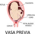Vasa praevia is fetal blood vessels cross