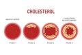 Vascular atherosclerosis. Stages of atherosclerosis Cholesterol in arteries, vessels. Medicine, science, healthcare. infographic