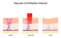 Vascular birthmarks removal