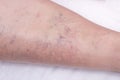 Vascular marks on the skin from varicose veins, vascular pattern on the skin, close-up, phlebeurysm, problem, white background