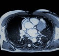 Vascular pathology ascending aorta aneurism mri