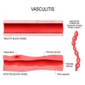 Vasculitis is damange of blood vessels by inflammation.