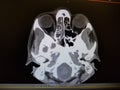 Vasculitis with ethmoid sinusitis - CT Scan of the Sinuses and Face