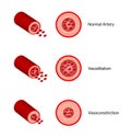 Arterial vasoconstriction and vasodilation. Comparison of normal, constricted, and dilated blood vessels. Vector illustration.