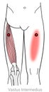 Vastus Intermedius: Managing pain arriving from myofascial trigger points in the Vastus Intermedius muscle