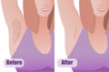 armpit laser hair removal result, before and after procedure, girl smooth skin, body hair removal procedure, beauty
