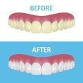 Vector Background with 3d Realistic Render Denture Set Closeup Isolated. Dentistry and Orthodontics Design. Human Teeth