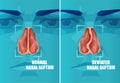 Vector cross section of face with deviated and normal nasal septum