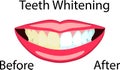 Vector face of girl and smile with bad and ideal white teeth for dental and stomatological illustrations Royalty Free Stock Photo