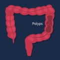 Vector flat endoscopic colon cancer polyps checkup Royalty Free Stock Photo