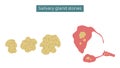 Stones in the parotid, submandibular and sublingual salivary glands