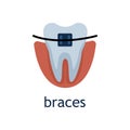 Vector flat illustration of a tooth with brace