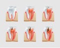 Vector healthy tooth and dental caries icon set