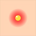 Vector illstration of acne on skin icon. Flat design. EPS10. Royalty Free Stock Photo