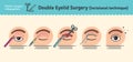 Vector Illustrated set with double eyelid surgery