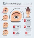 Vector Illustrated set with double eyelid surgery. Non-incisional technique