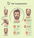 Vector Illustrated set with hair transplant surgery