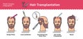 Vector Illustrated set with hair transplant surgery