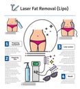 Vector Illustrated set with Laser LIPO Fat Removal