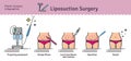 Vector Illustrated set with liposuction surgery Royalty Free Stock Photo