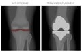 Meniscus _Arthritic knee and Total knee replacement Royalty Free Stock Photo