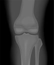 Meniscus _X Ray knee front