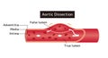 Vector illustration of aortic dissection Royalty Free Stock Photo