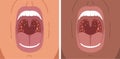 Vector illustration of bacterial tonsillitis, sore throat Royalty Free Stock Photo