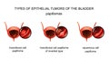 Epithelial tumors of the bladder