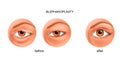 Blepharoplasty of the overhanging eyelid and Asian eyelid