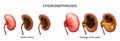 Blockage of the ureter . hydronephrosis.