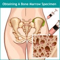 VECTOR ÃÂ°LLUSTRATÃÂ°ON OF A BONE MARROW ASPIRATION