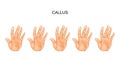 Calluses on hands