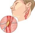 vector illustration of a Carotid Endarterectomy Royalty Free Stock Photo