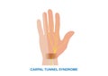 Vector illustration of carpal tunnel syndrome Royalty Free Stock Photo