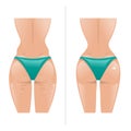 Vector illustration of cellulite and healthy skin