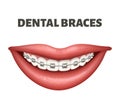 Vector illustration of the dental braces. Image showing human smile and braces on the white teeth. Royalty Free Stock Photo