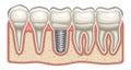 Vector illustration of Dental Implant Royalty Free Stock Photo