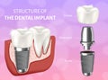 Vector illustration depicting the structure of the dental implant. Design concept of the dental implant process. Royalty Free Stock Photo