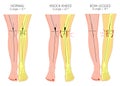 Shapes of the legs.Normal and curved legs.Knock knees.Bowed leg