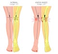 Shapes of the legs.Normal and curved legs.Knock knees.Bowed leg