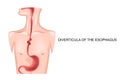 Diverticula of the esophagus