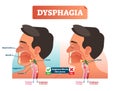 Vector illustration about dysphagia. Human scheme with nasal cavity, mouth, tongue, epiglottis, larynx, trachea and esophagus.