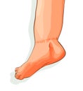 Vector illustration of edema on feet. Swelling of the feet and ankles. Isolated