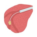 Vector illustration of endoscopic surgery to remove a stone from the salivary gland