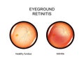 Eye, fundus. retinitis Royalty Free Stock Photo