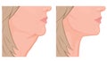 Face side view_Neck lift before and after